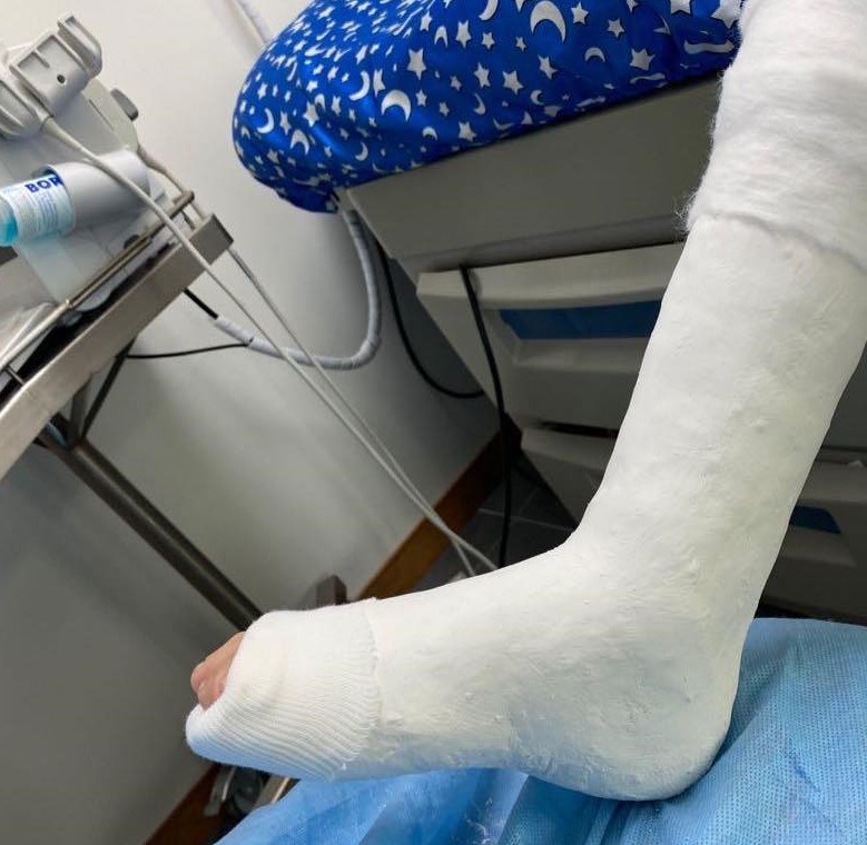 ectrodactilia deformidad en  pie