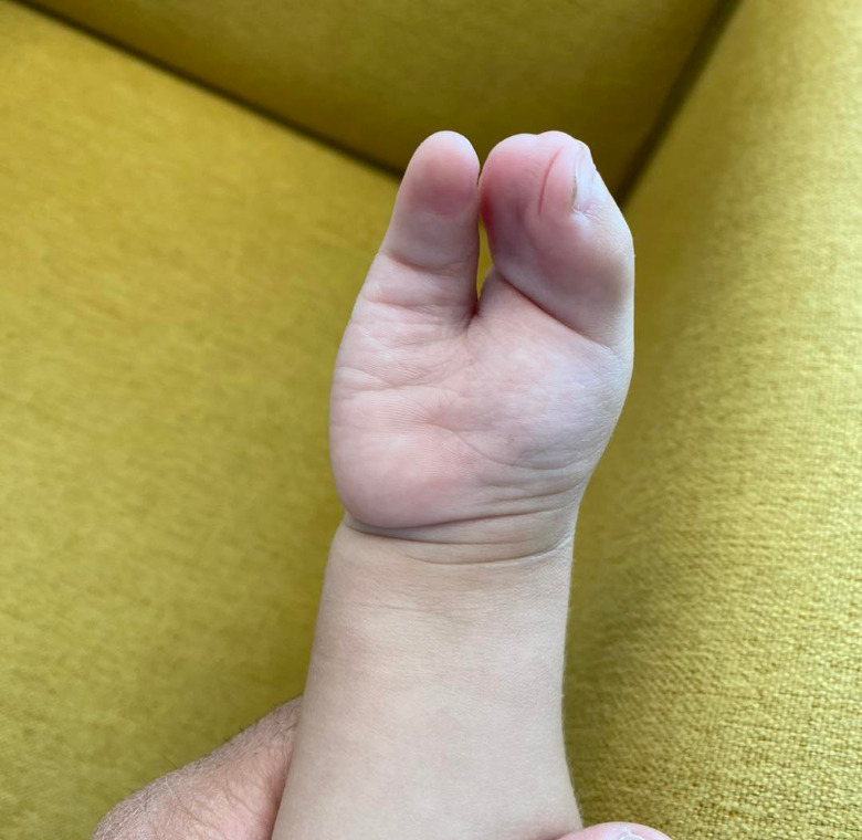 cirugía de reconstrucción mano