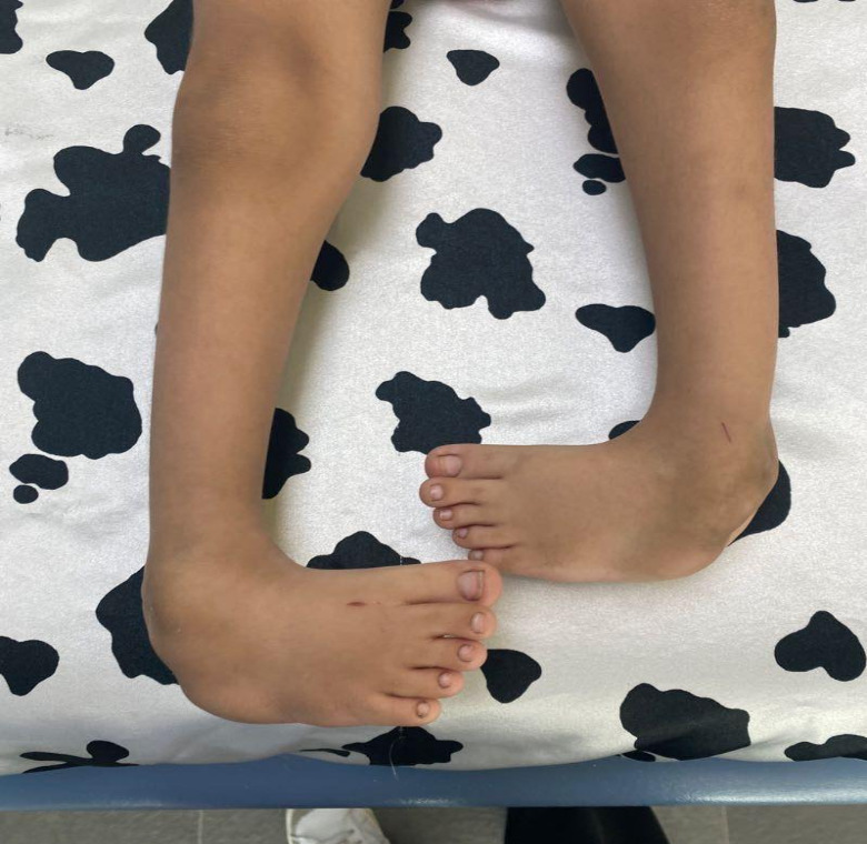 Atrogriposis con cadera luxada