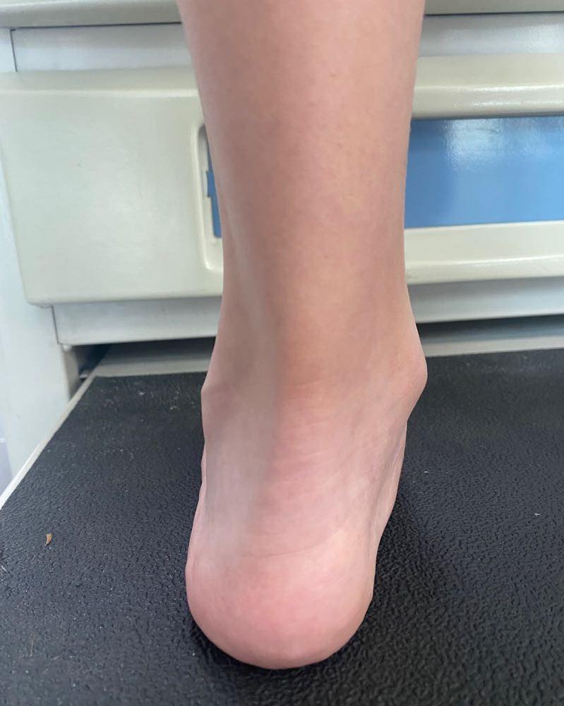 pie plano limitacion 6