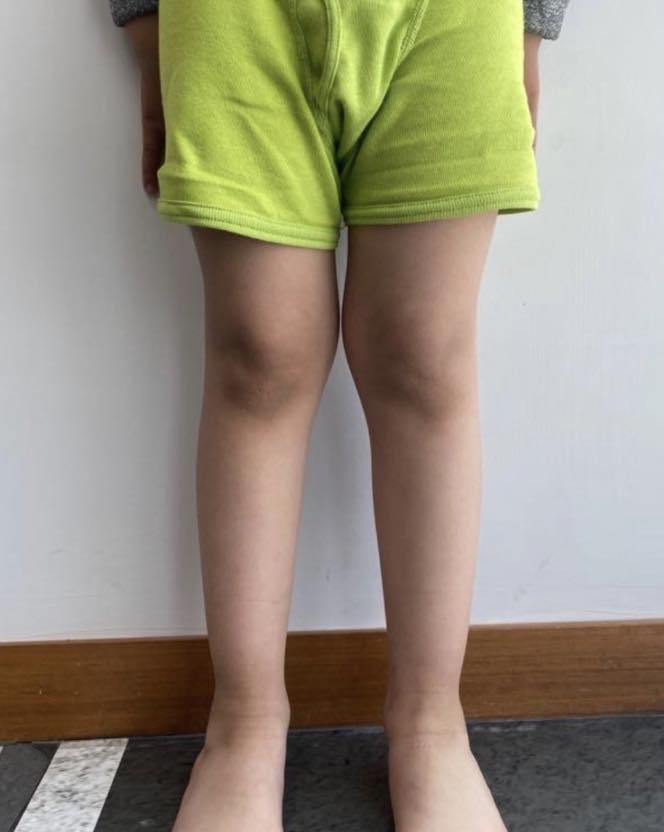 pie plano limitacion 5