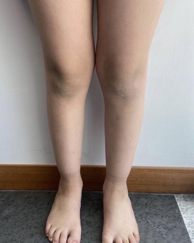 pie plano limitacion 6