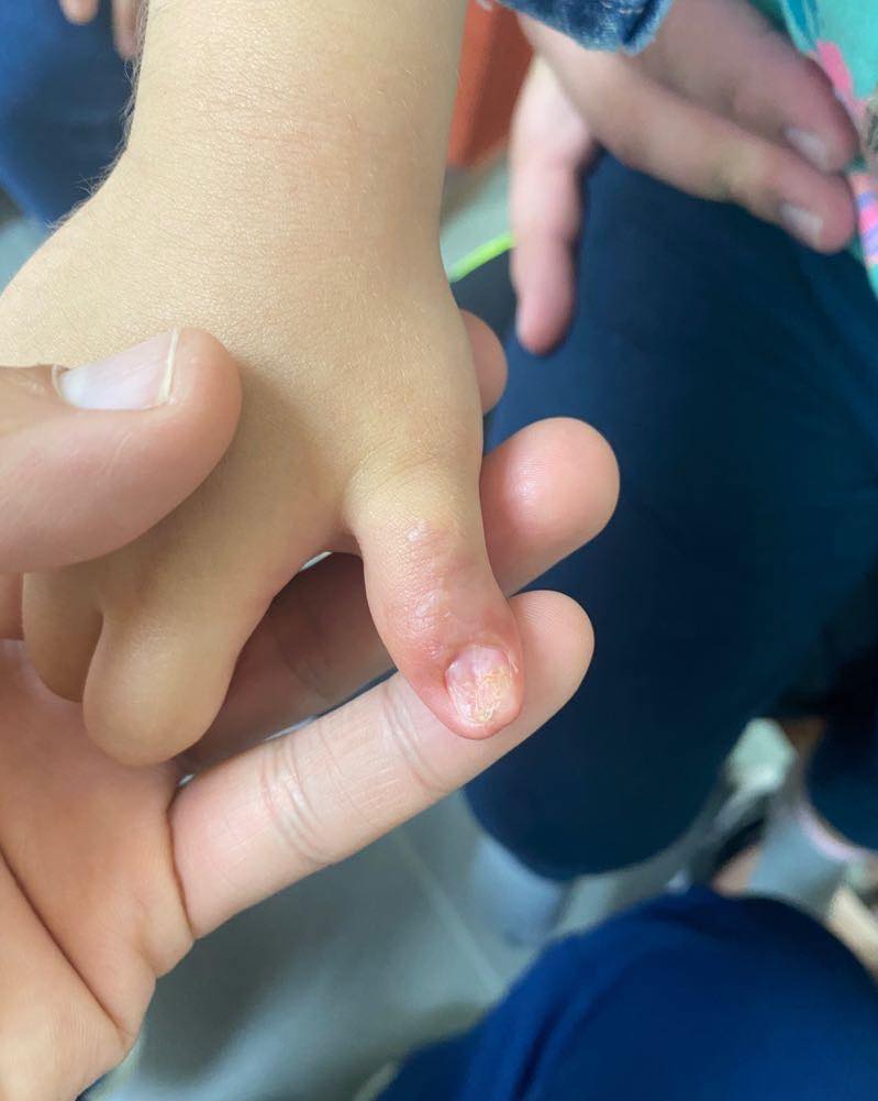 recostruccion de pulgar 4