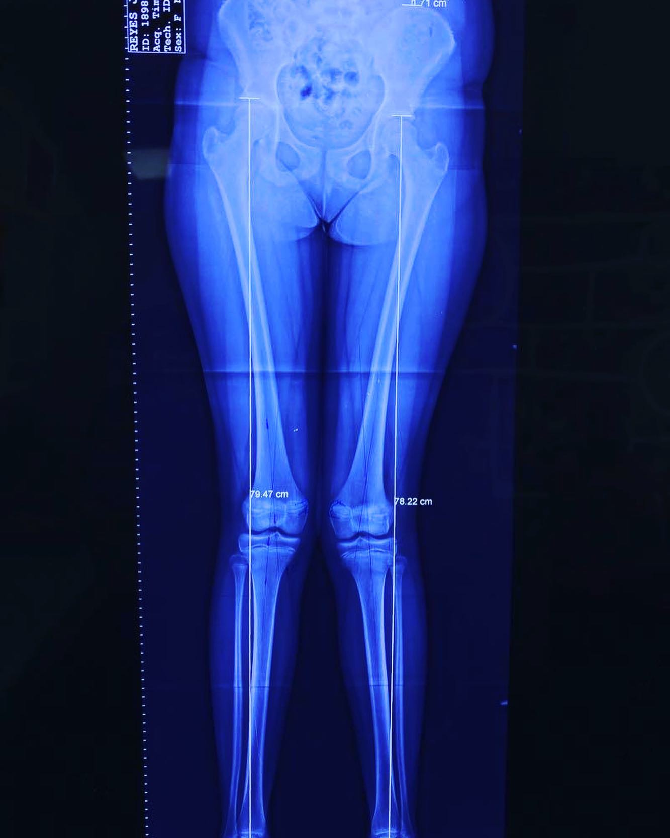 deformidad rodillas en valgo 3