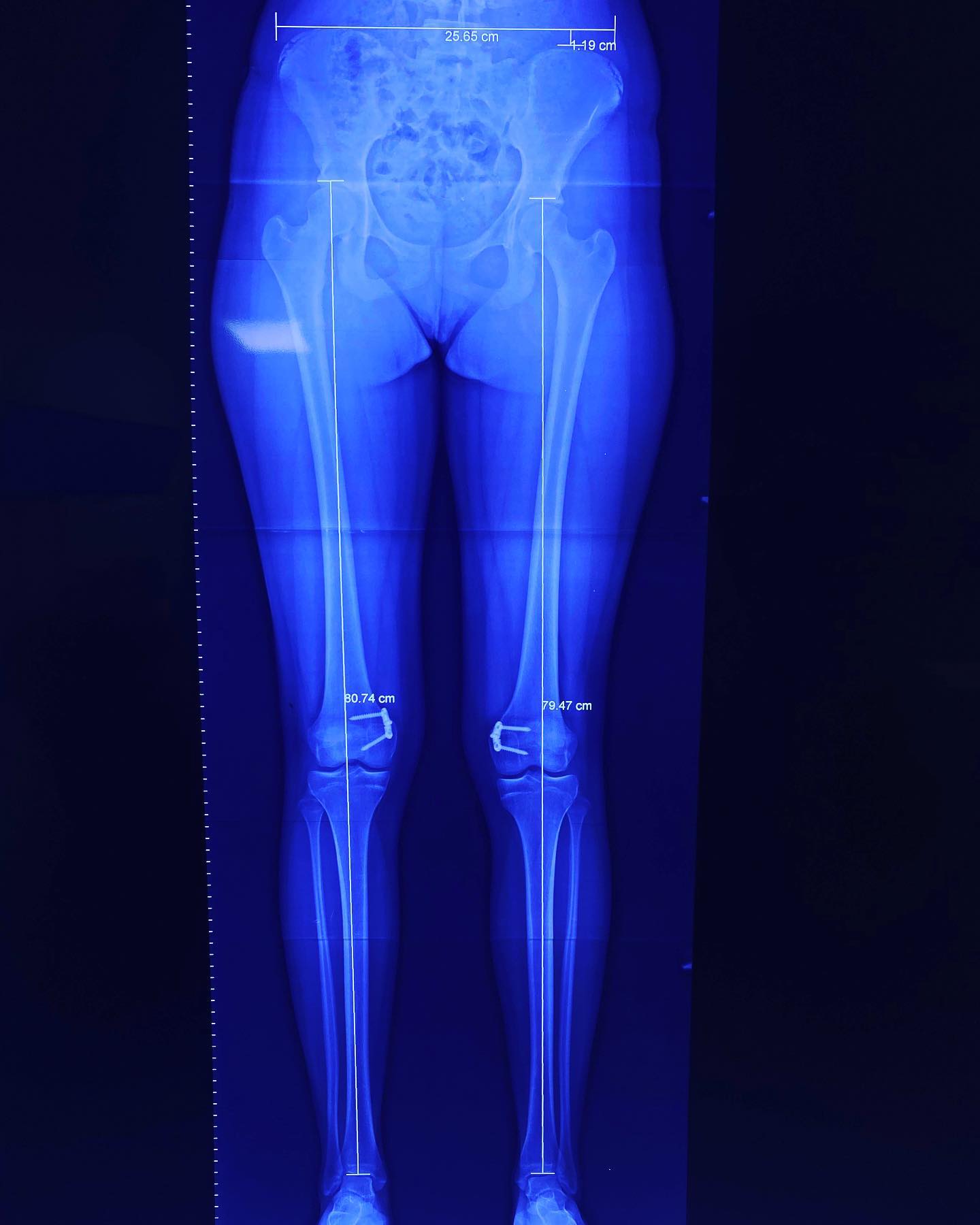 deformidad rodillas en valgo 5