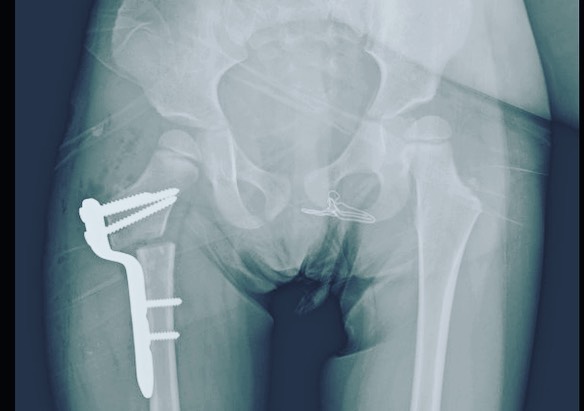 displasia de cadera 3