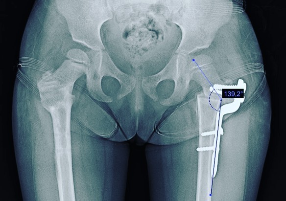 displasia de cadera 4