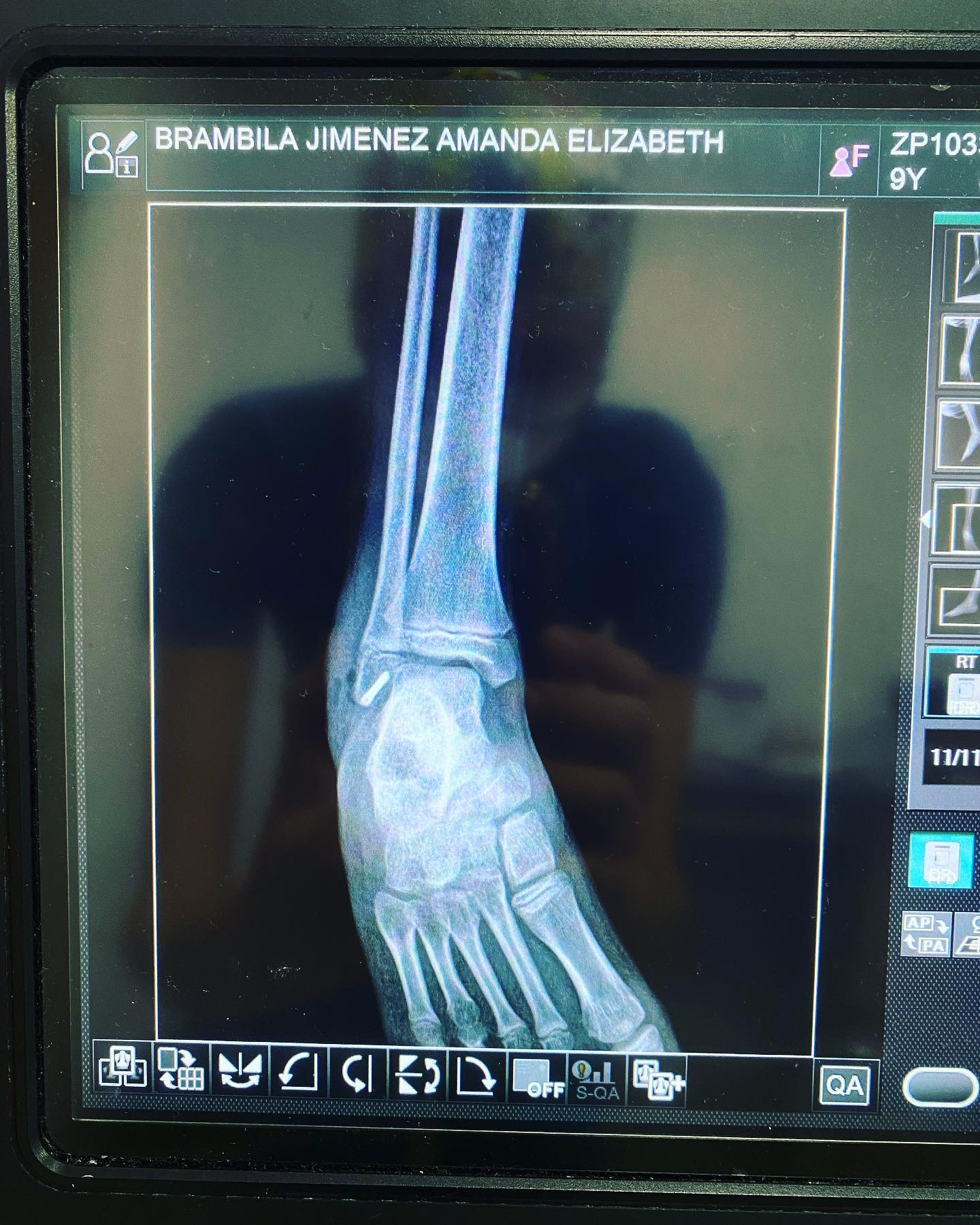 fractura de tobillito 5