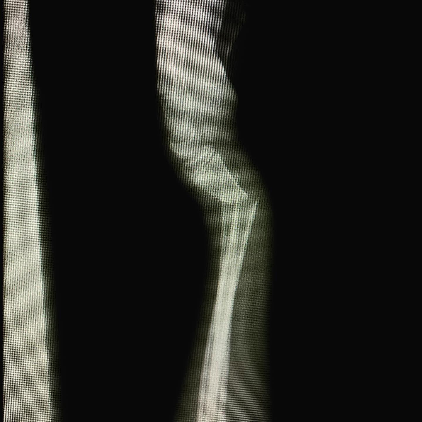 fractura de antebrazo 3