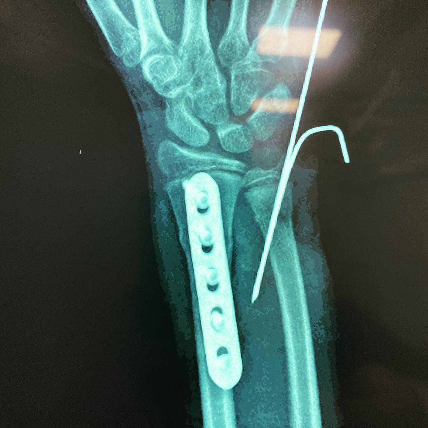 fractura de antebrazo 4