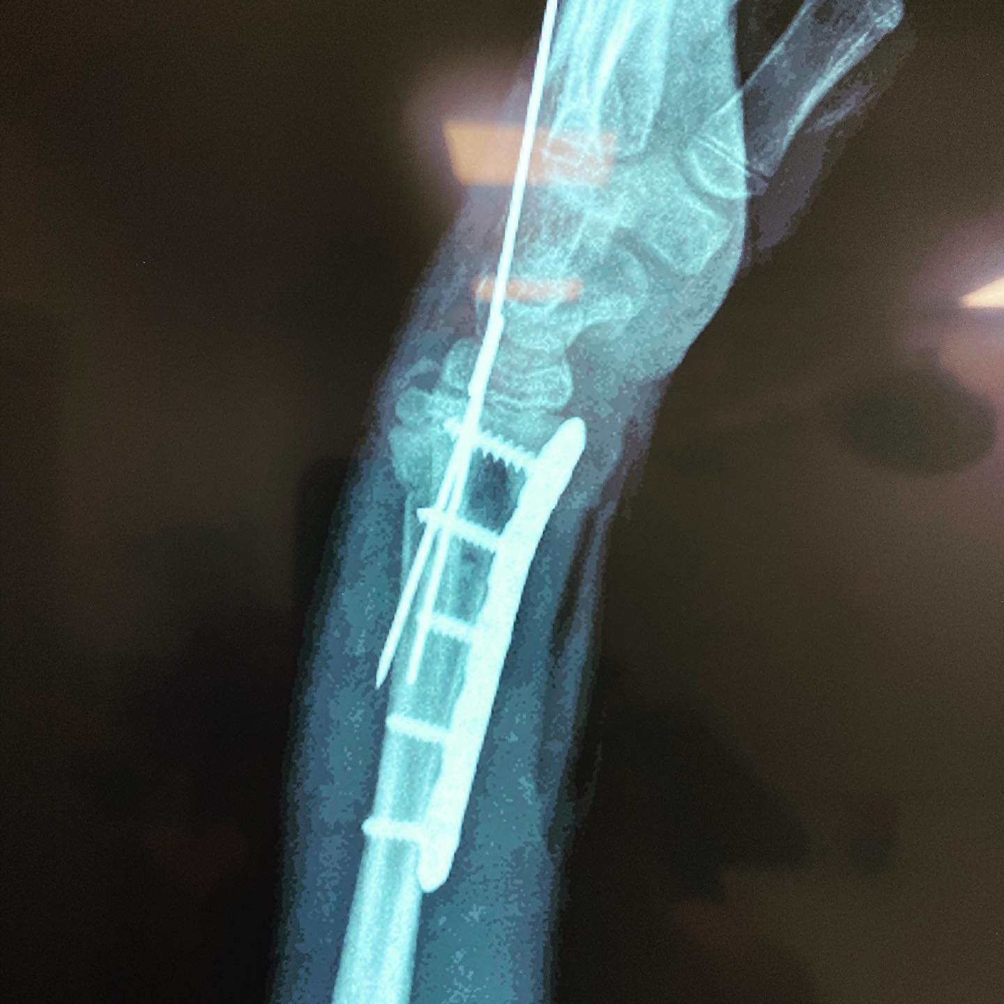 fractura de antebrazo 5