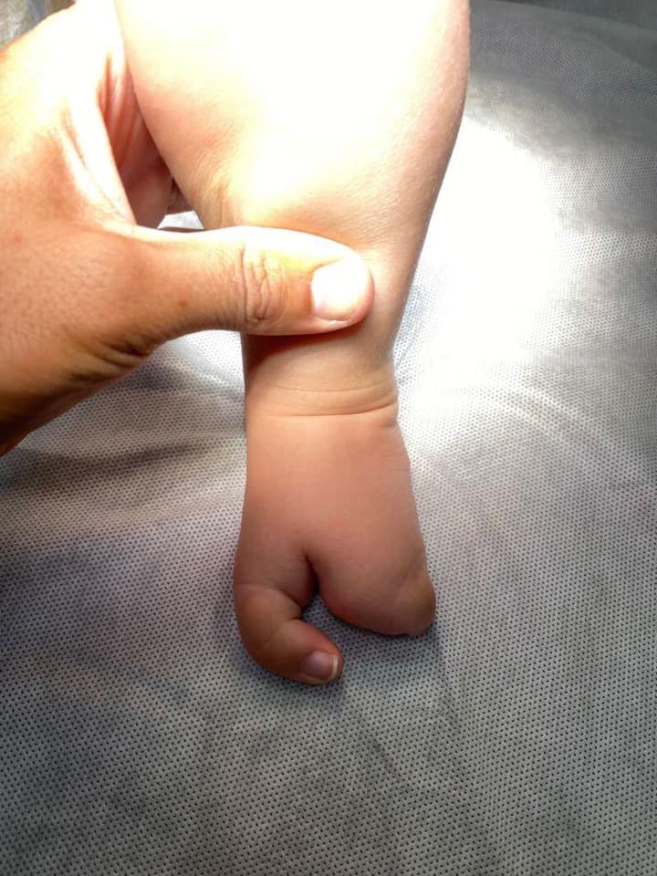 ectrodactilia deformidad en pie 2