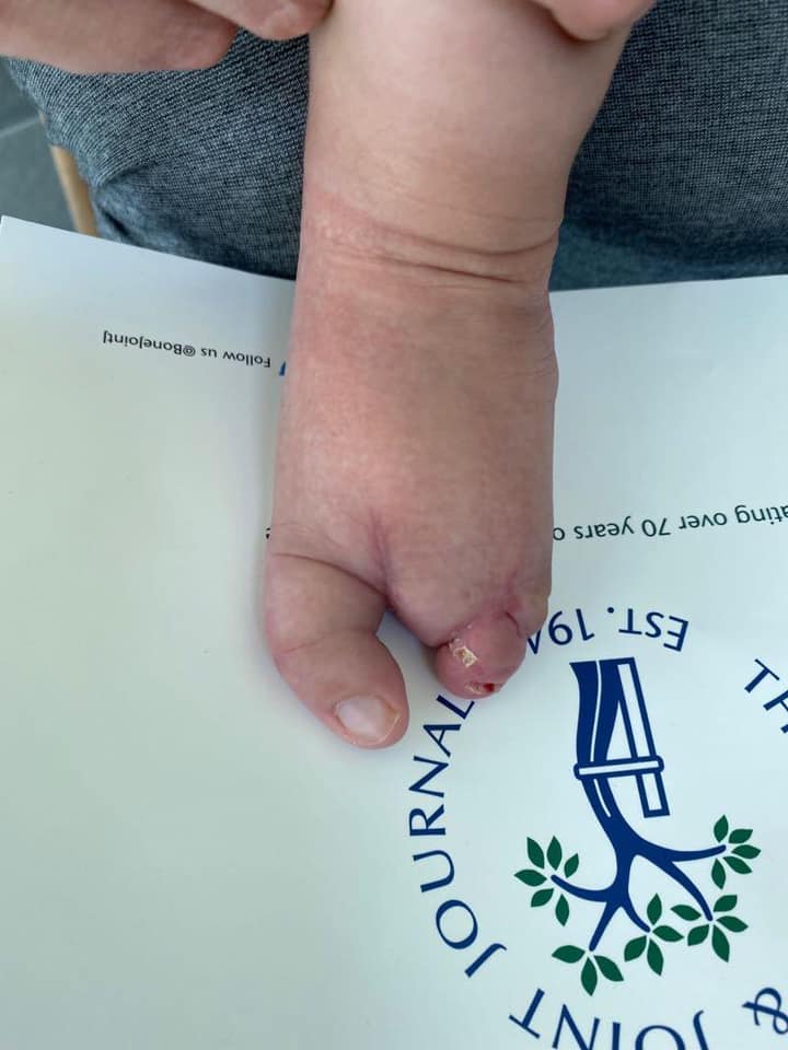 ectrodactilia deformidad en pie 7