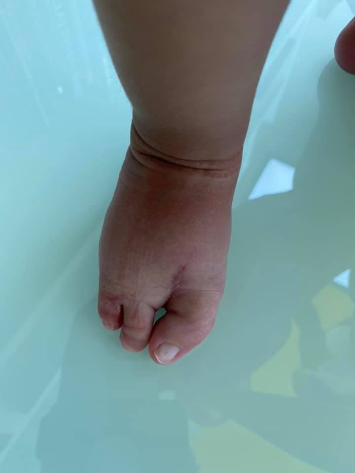 ectrodactilia deformidad en pie 8