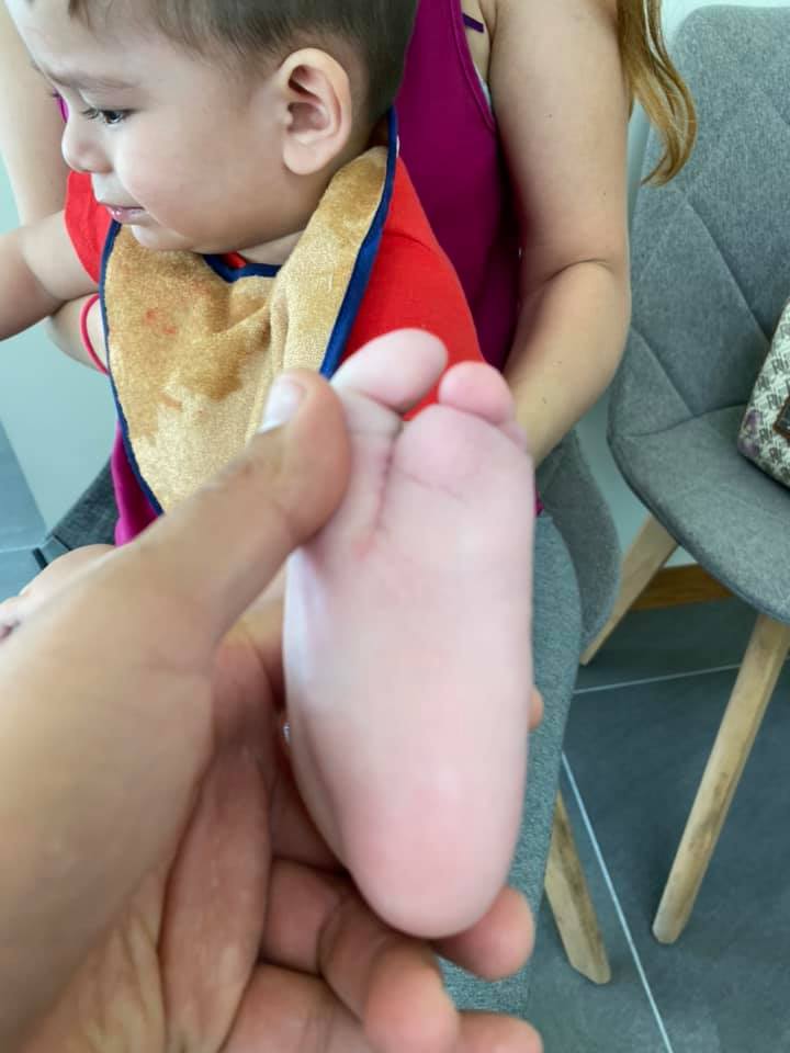 ectrodactilia deformidad en pie 9