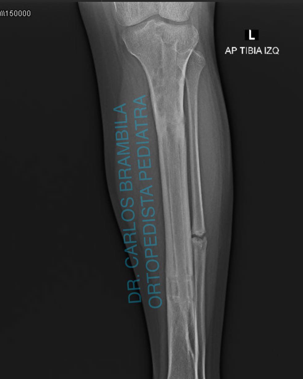 fractura de tibia 6