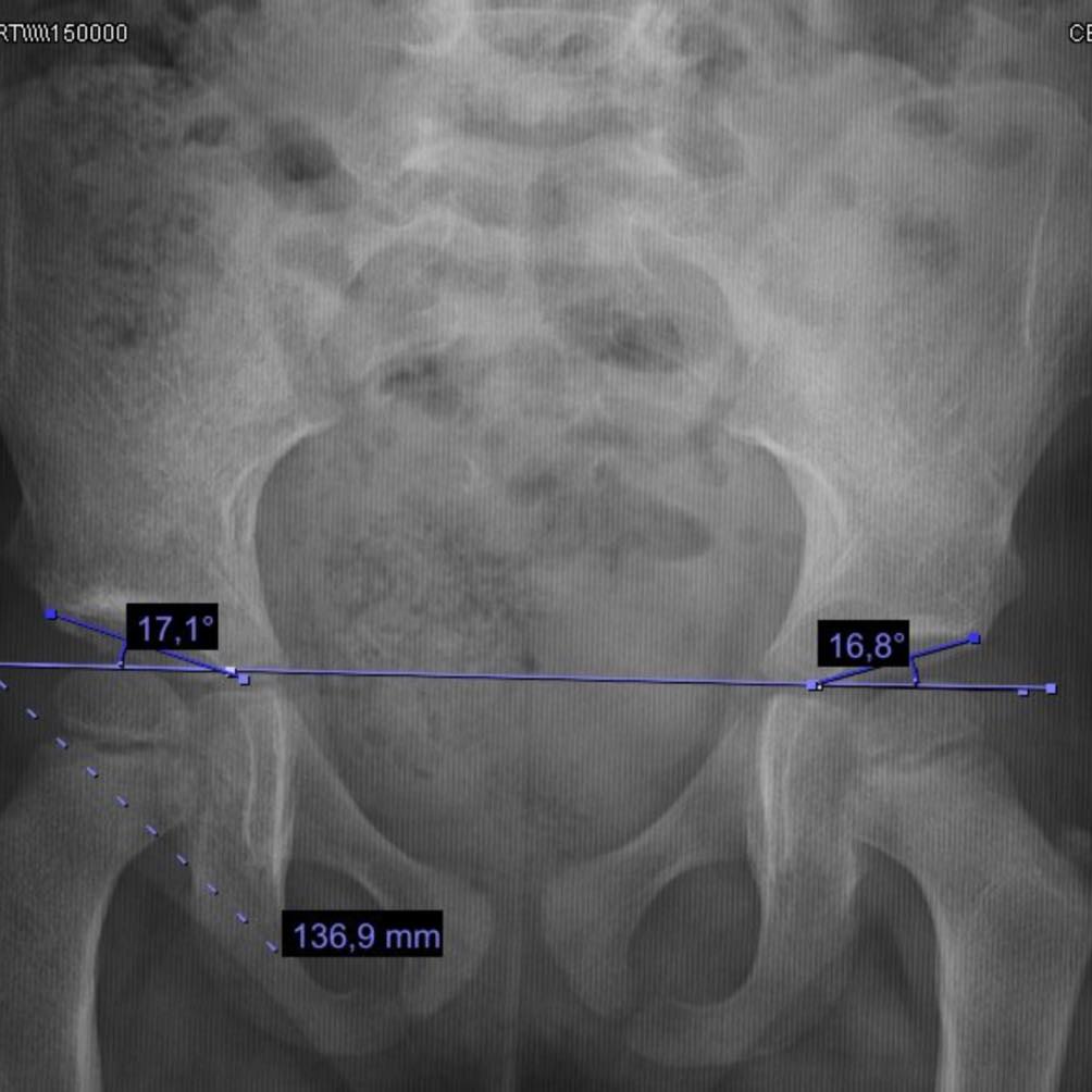 displasia de cadera 3