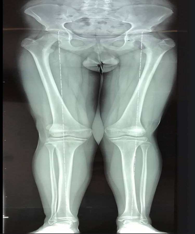 Rodillas en valgo con rótula alta 4