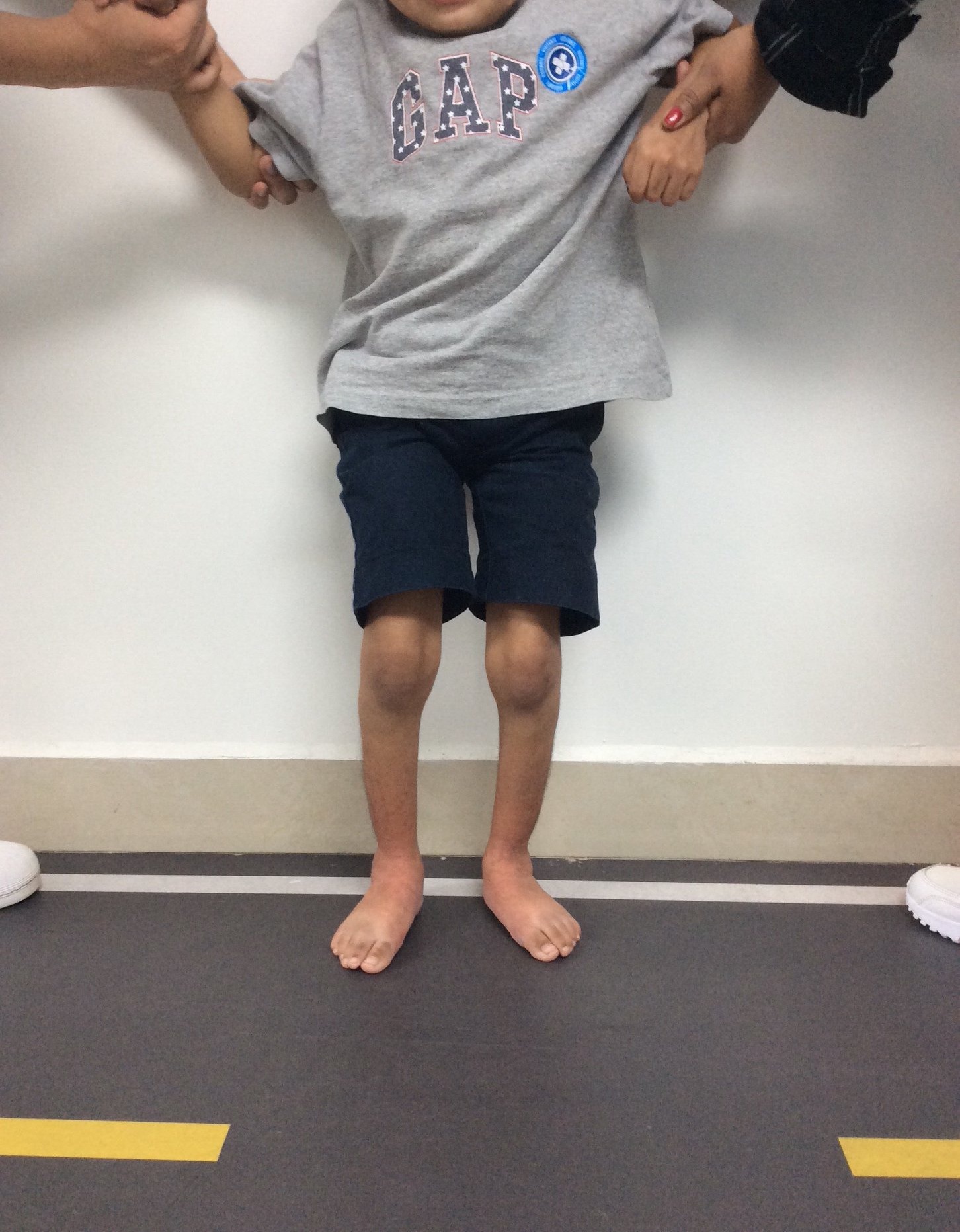 Enfermedad neurológica deformidad en pies 3