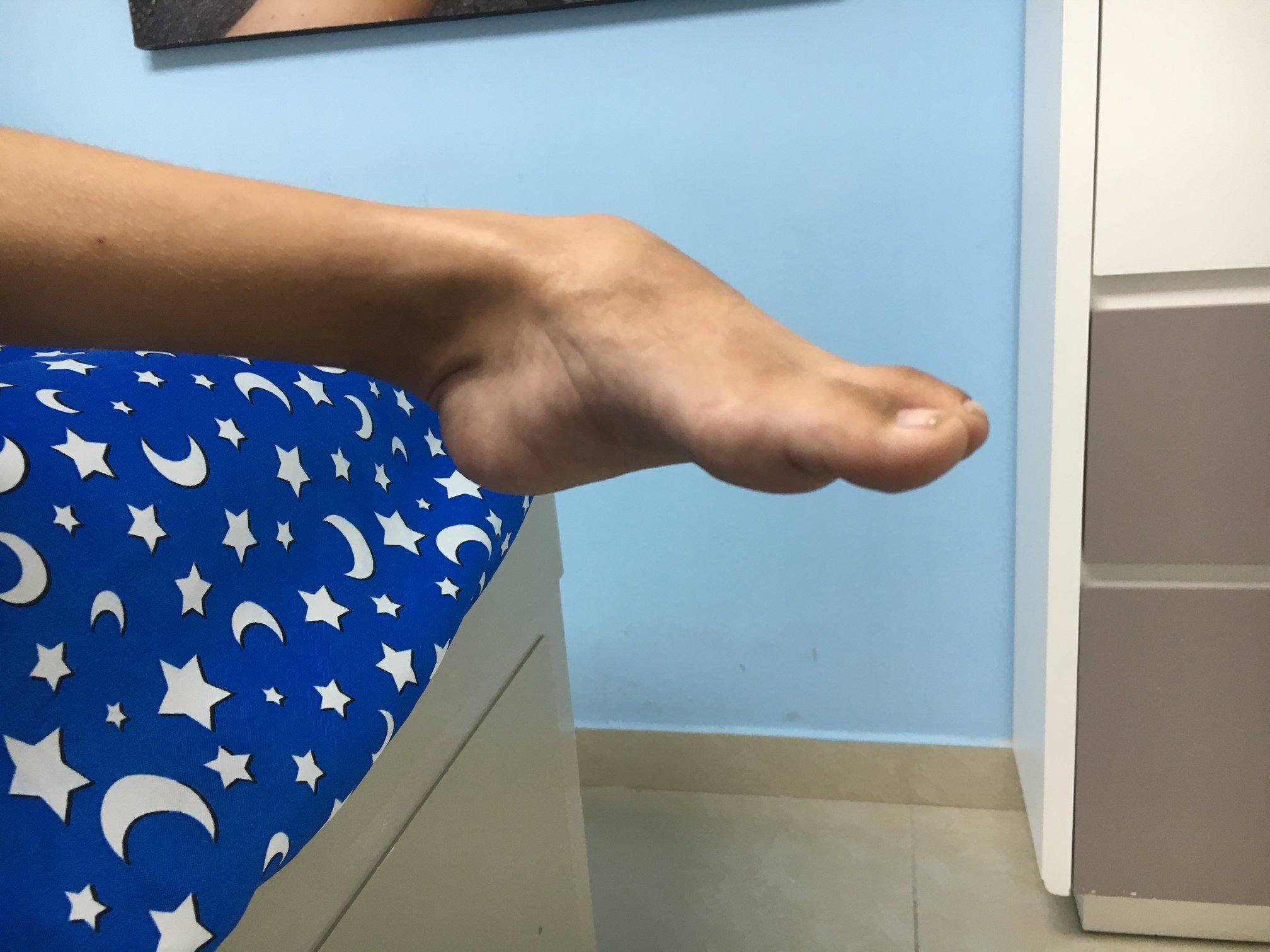 Enfermedad neurológica deformidad en pies 5