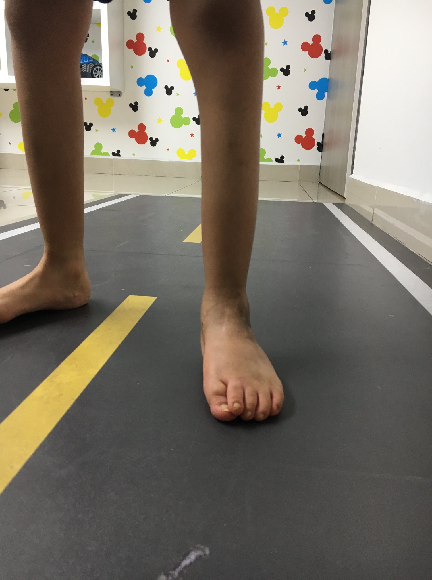 Enfermedad neurológica deformidad en pies 3