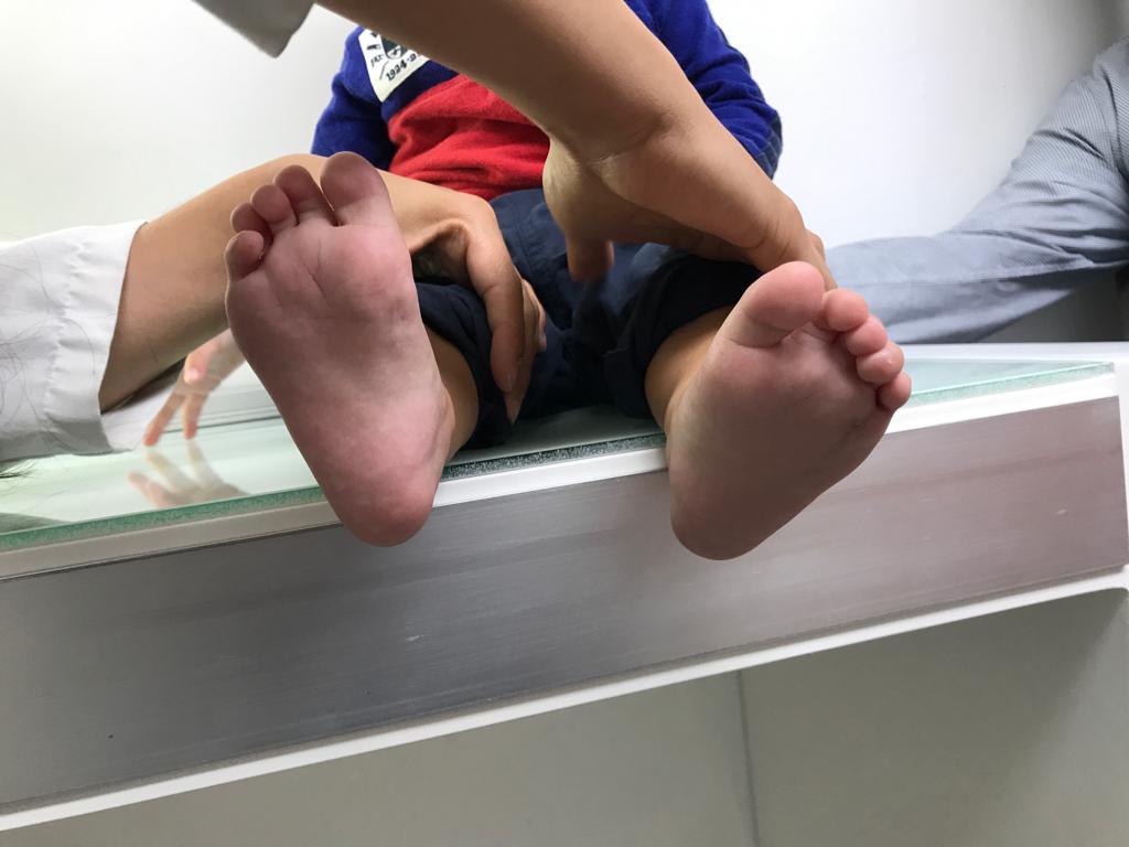 polidactilia en ambos pies 4