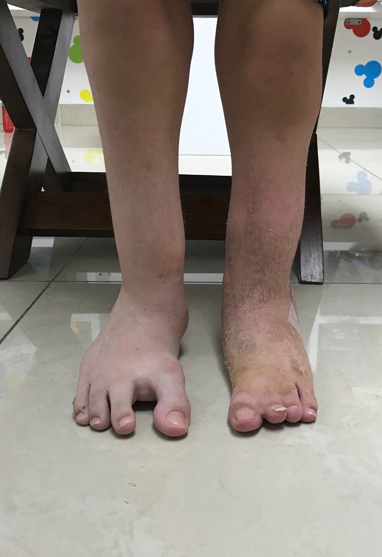 Ausencia congenita del peroné 3