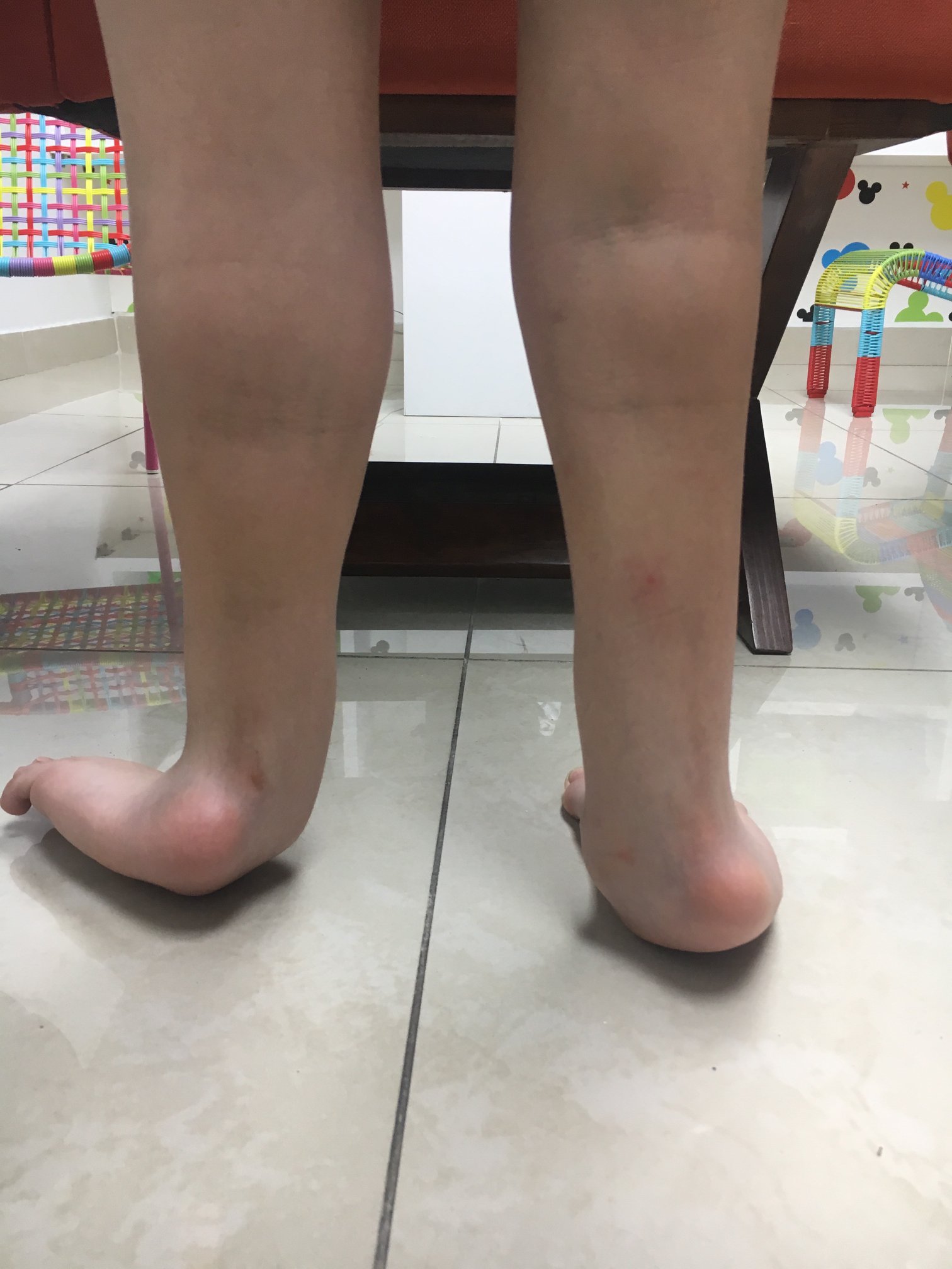 Ausencia congenita del peroné 4