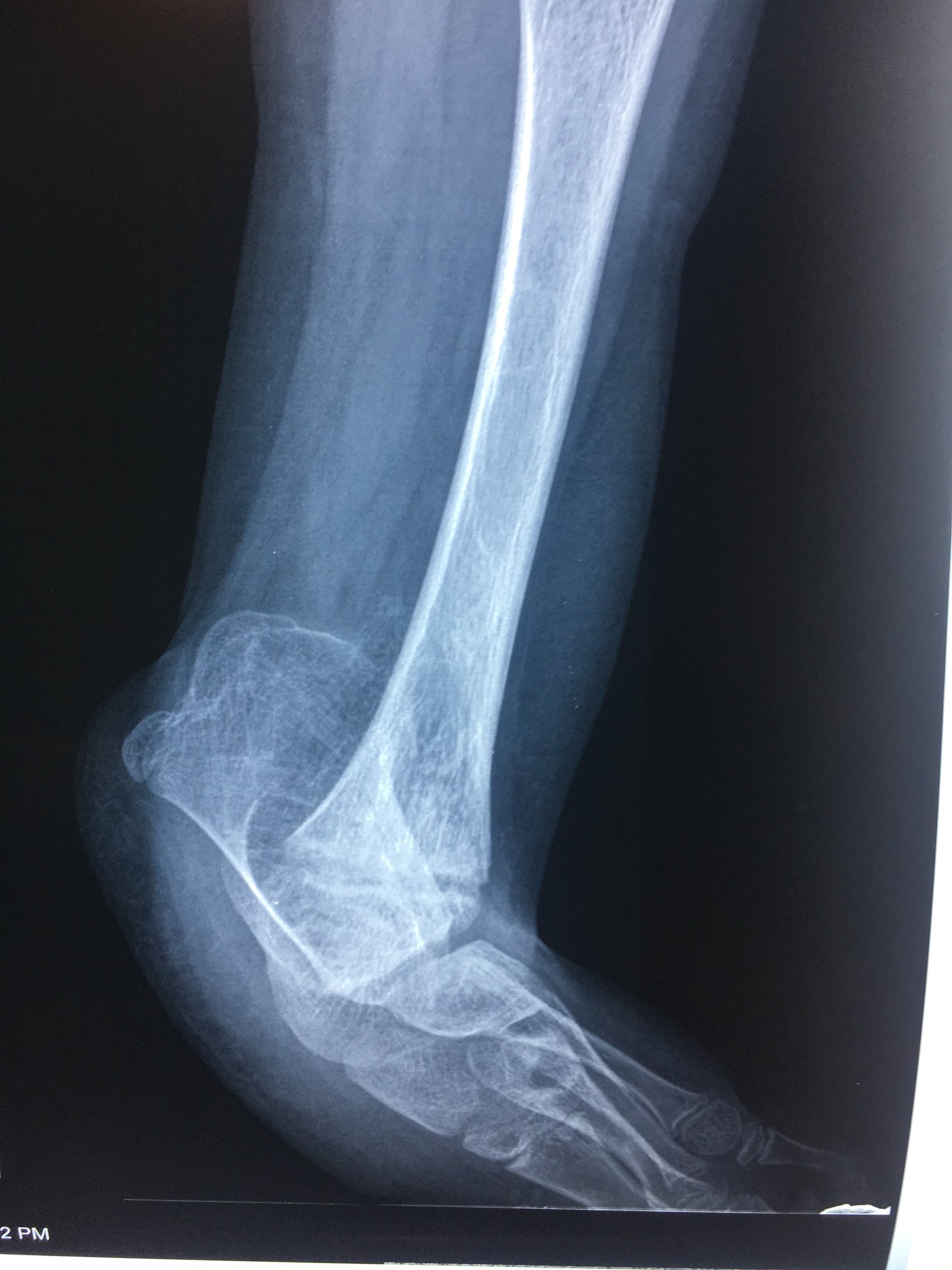 Ausencia congenita del peroné 4