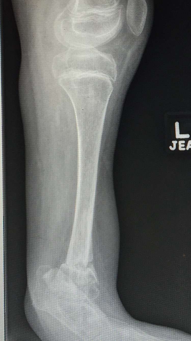 Ausencia congenita del peroné 4