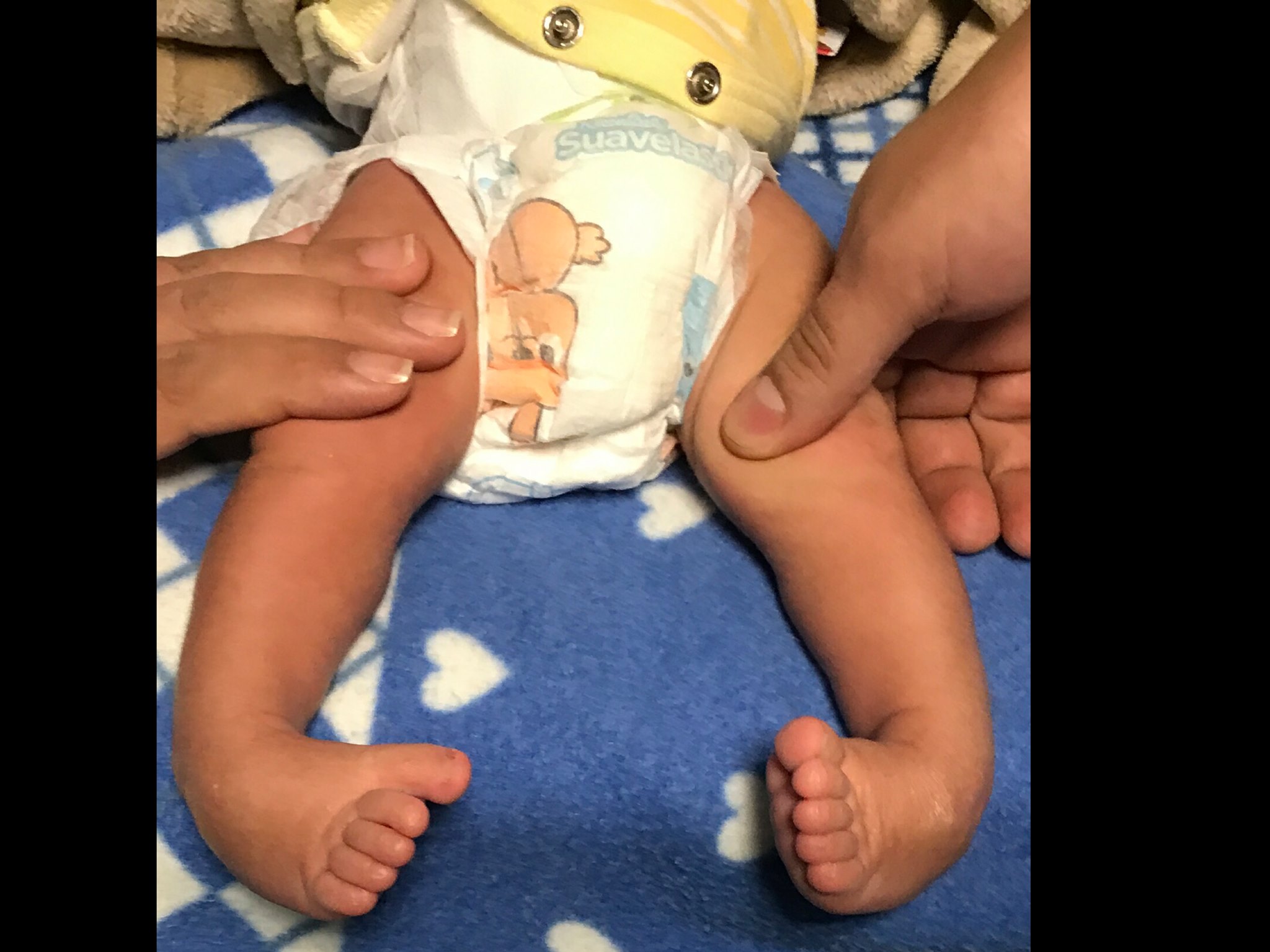 Inicio tratamiento de pie equino varo 2