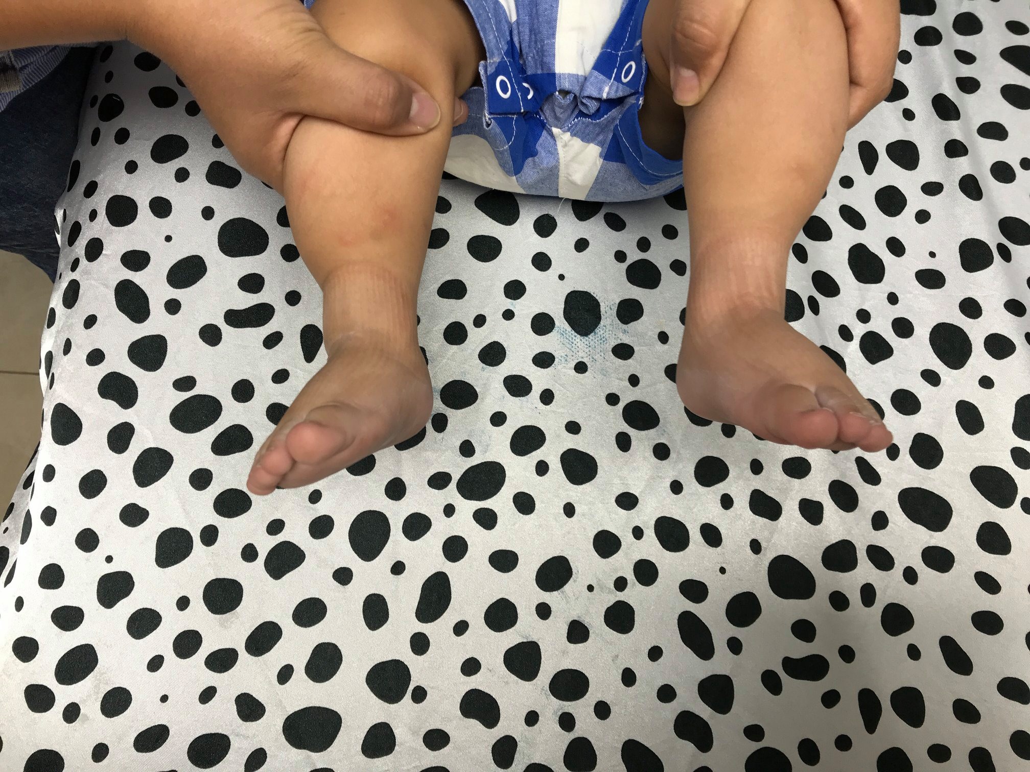 Inicio tratamiento de pie equino varo 3