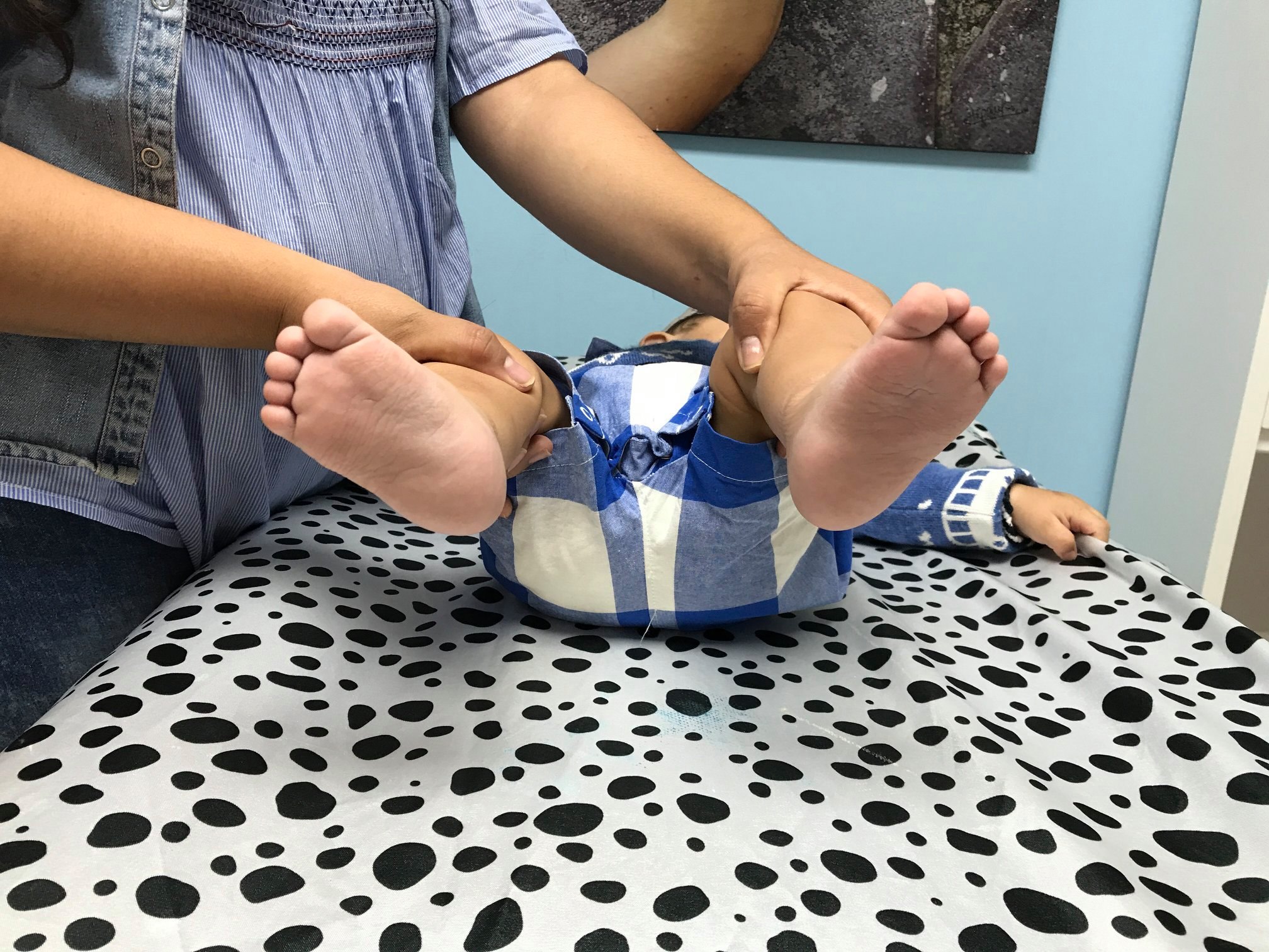 Inicio tratamiento de pie equino varo 5