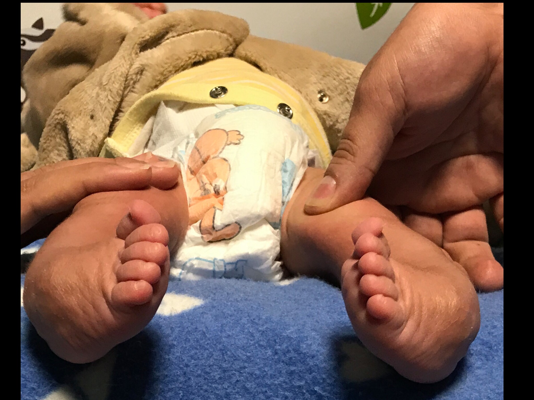 Inicio tratamiento de pie equino varo 6