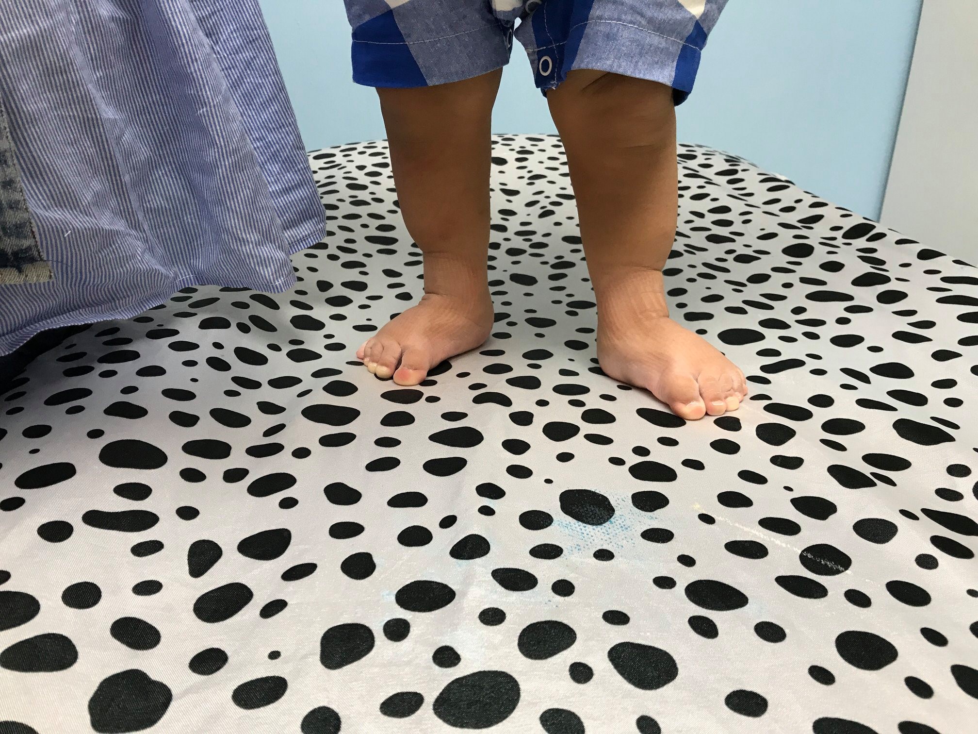 Inicio tratamiento de pie equino varo 7