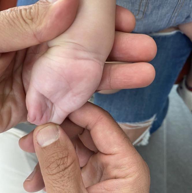 reconstrucción mano 3