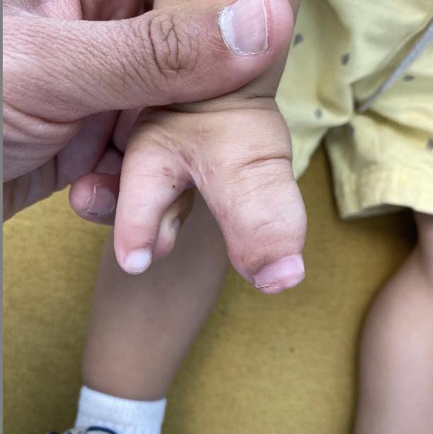 reconstrucción mano 4