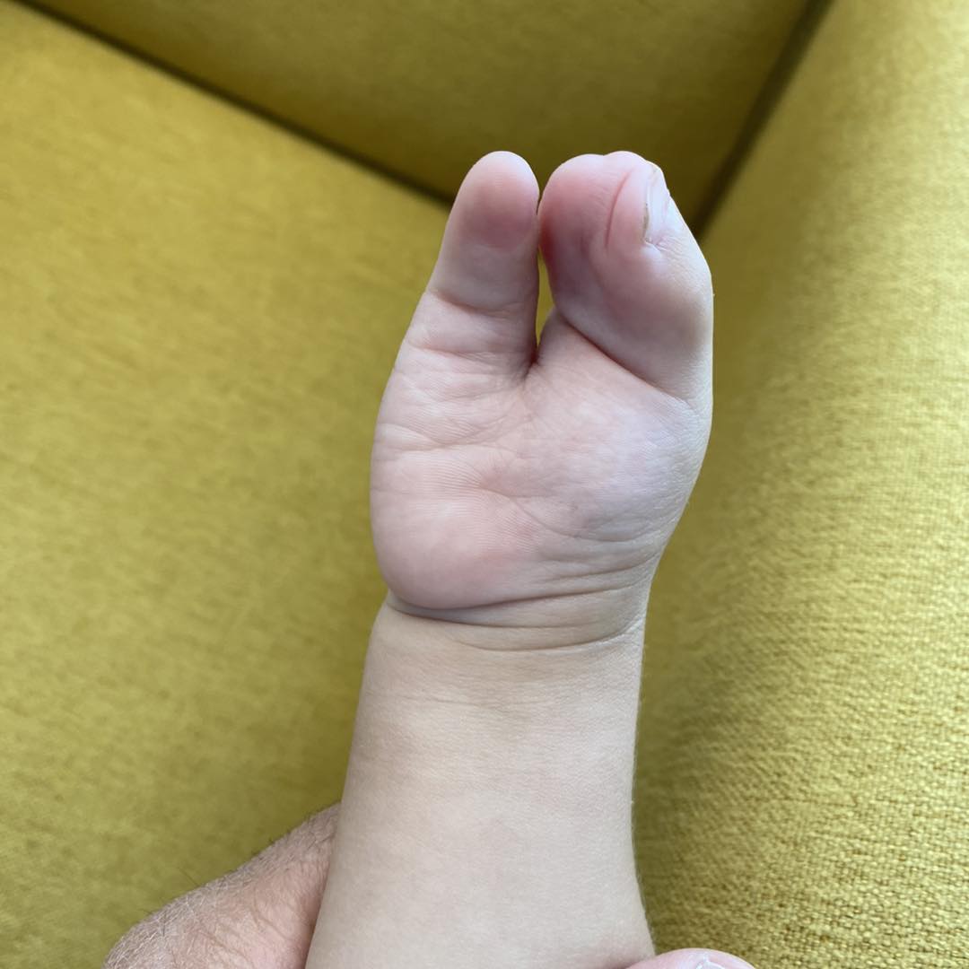 reconstrucción mano 8