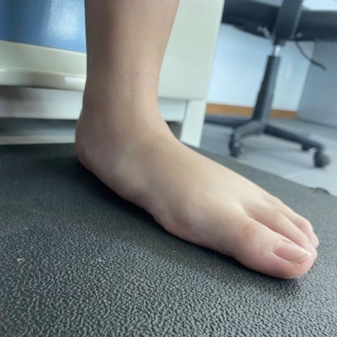 pies planos dolorosos 2