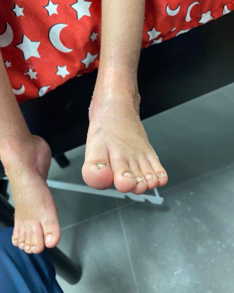 Atrogriposis con cadera luxada 7